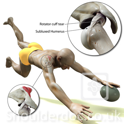 The rugby shoulder